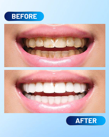 blanqueador de dientes