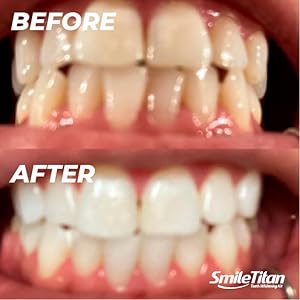 smile titan, smile titan teeth whitening, smile titan teeth whitening kit, teeth whitening kit