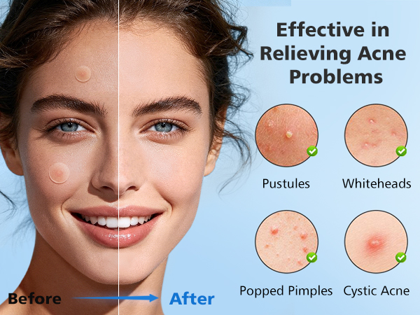 pimple patches
