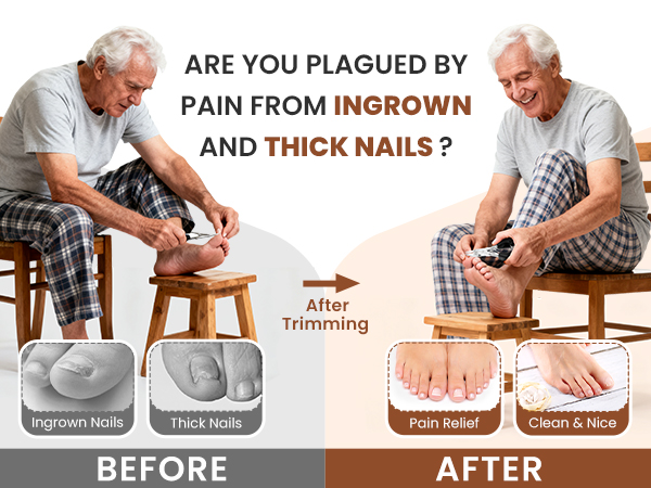 INGROWN AND THICK NAILS
