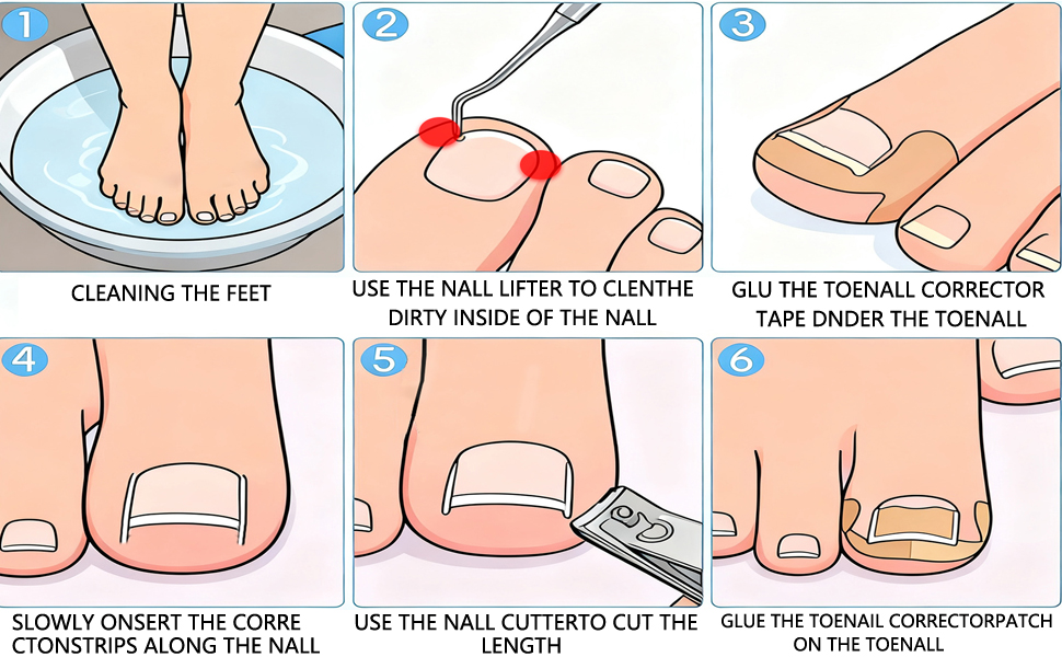 ingrown nail corrector