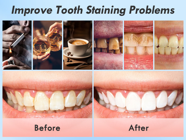 tartar remover for teeth