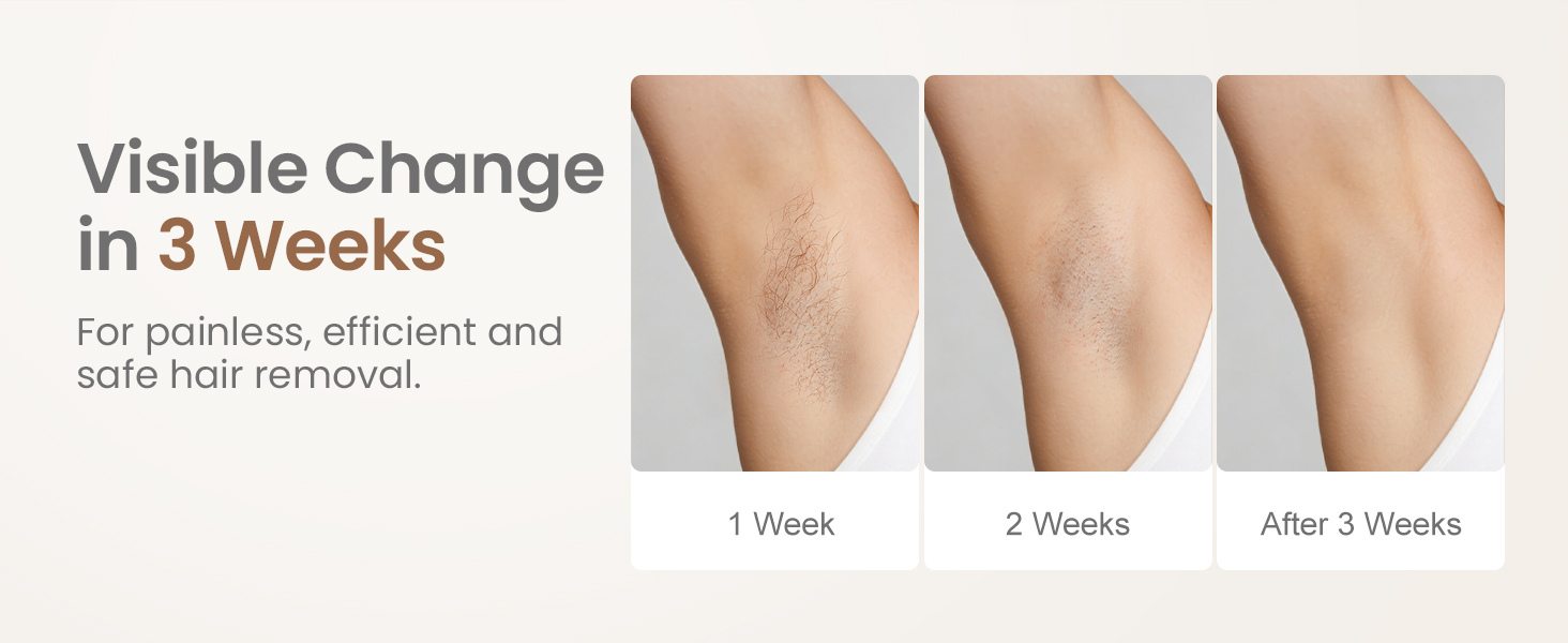 laser hair removal for women
