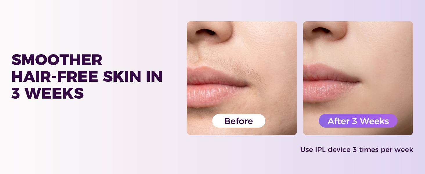 laser hair removal for women