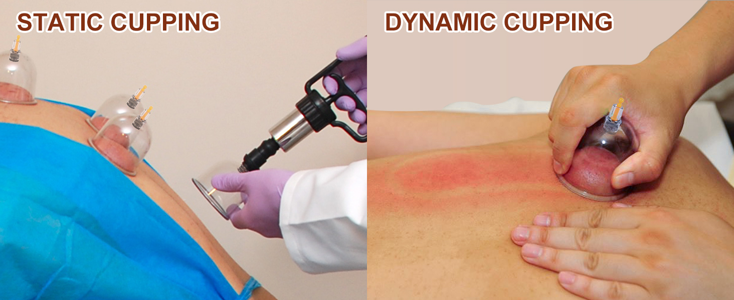 CUPPING SUPPORT