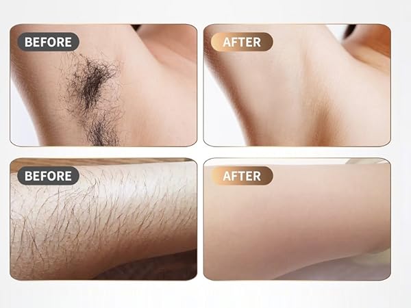 IPL Laser Hair Removal Device 2