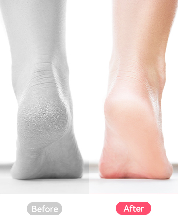 callus remover for feet