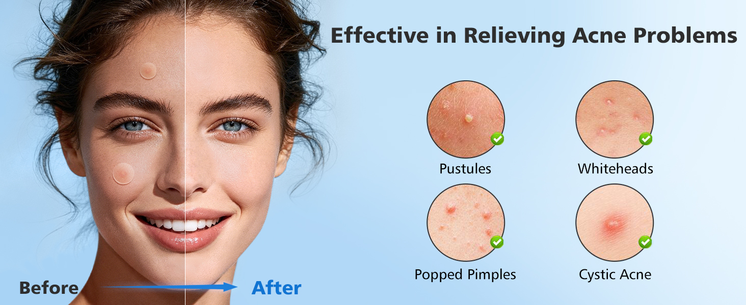 Pimple Patches 