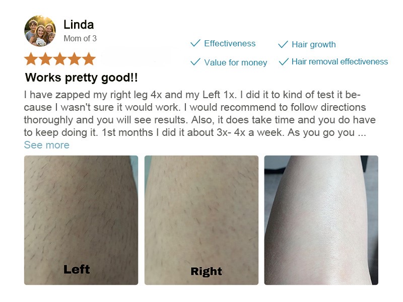 laser hair removal device