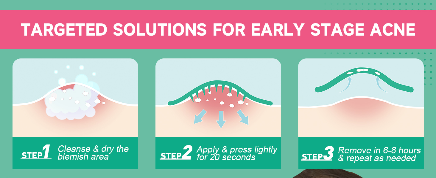 TARGETED SOLUTIONS FOR EARLY STAGE ACNE