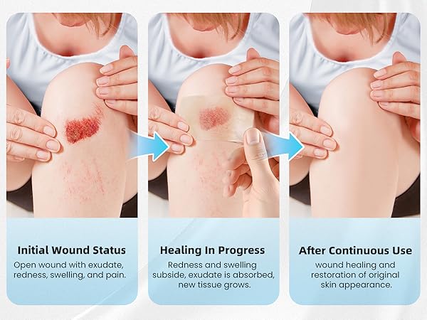 hydrocolloid bandages roll