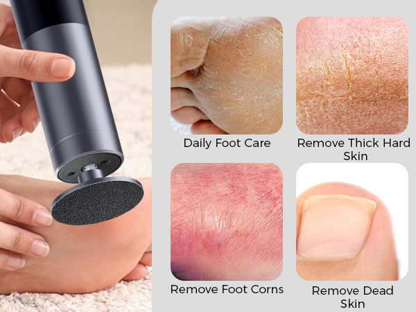 electric foot callus remover