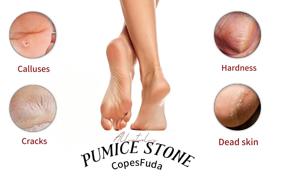 Calluses Hardness Cracks Dead skin