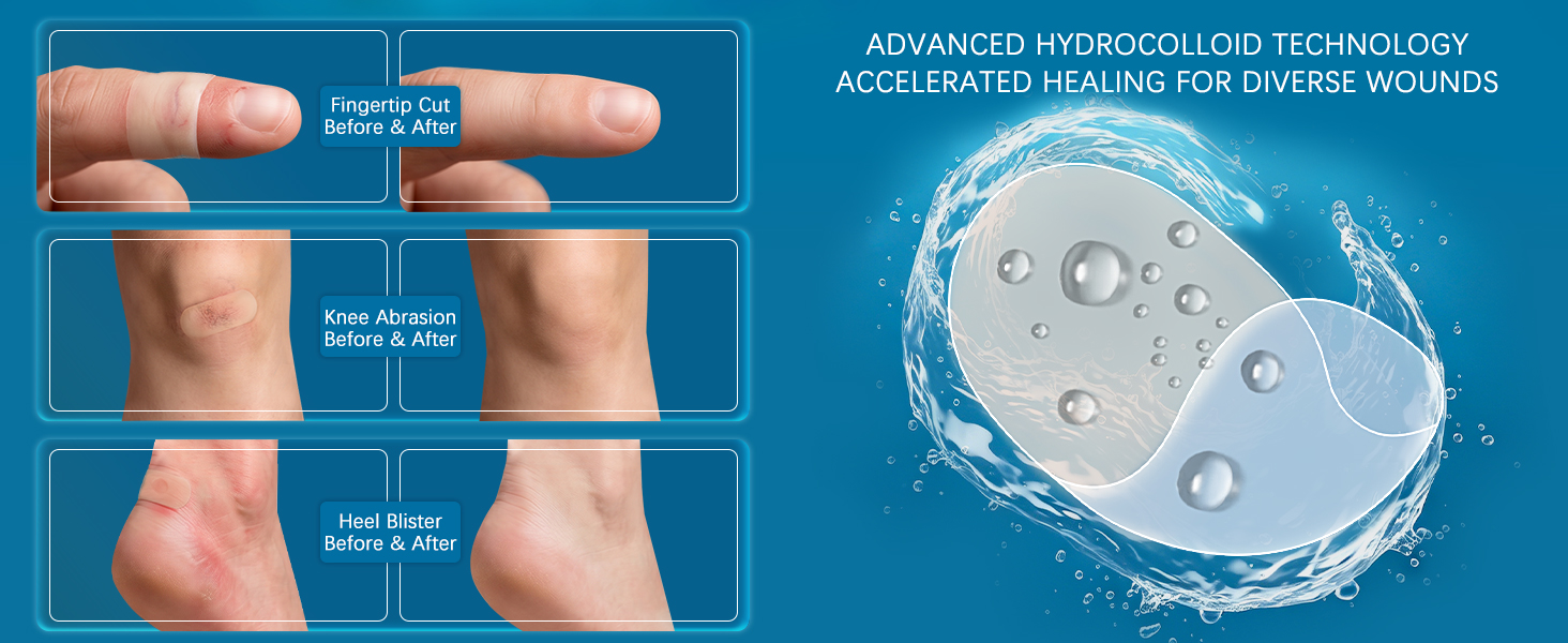 ADVANCED HYDROCOLLOID TECHNOLOGY ACCELERATED HEALING FOR DIVERSE WOUNDS (3)