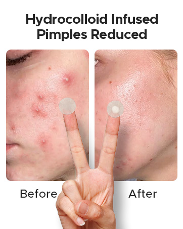 hydrocolloid pimple patch