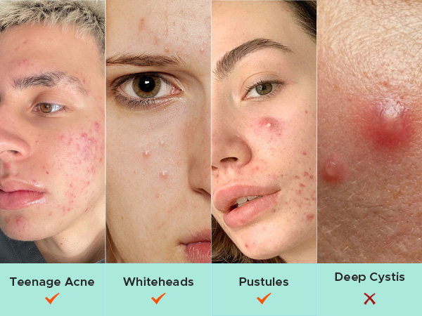 Acne patches
