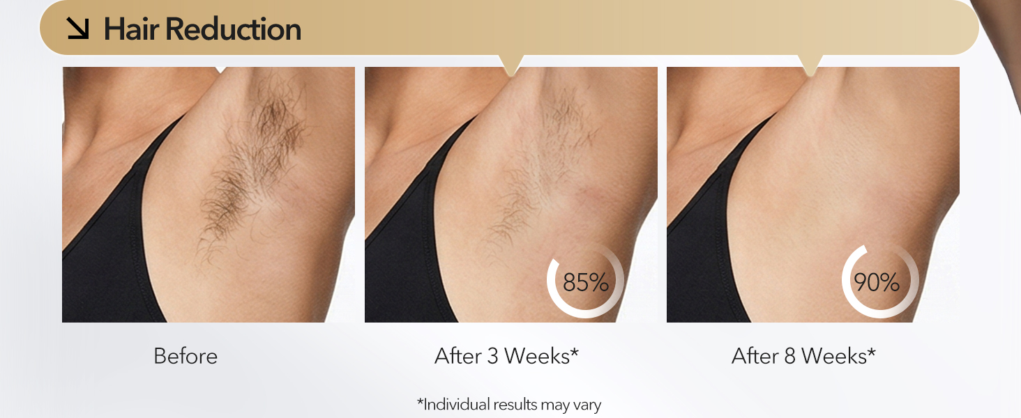 laser hair removal
