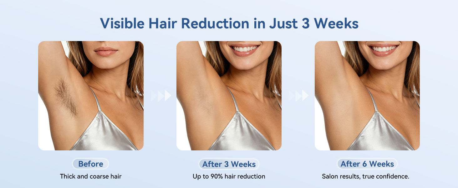 Laser hair removal for women permanent