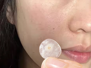 pimple patches
