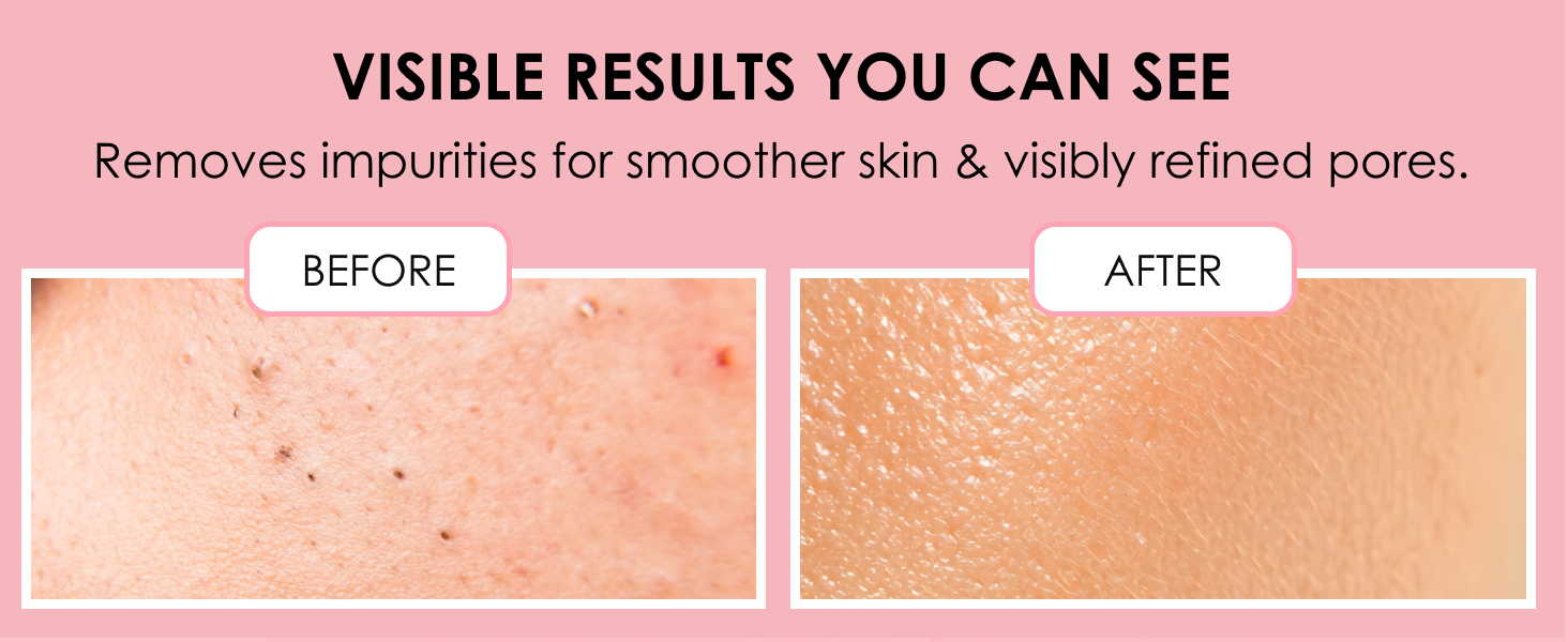 blemish skin tool
