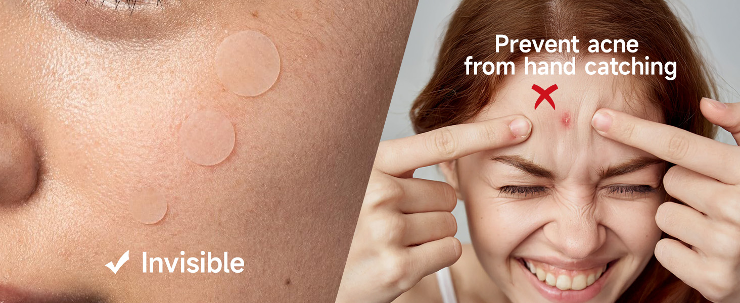 pimple patches